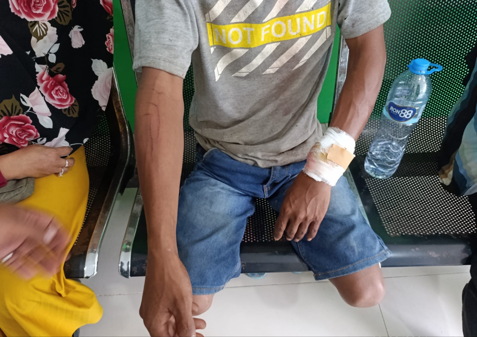 Diserang Buaya Rawa, Tangan Hasan Luka 21 Jahitan dan Tendon Putus