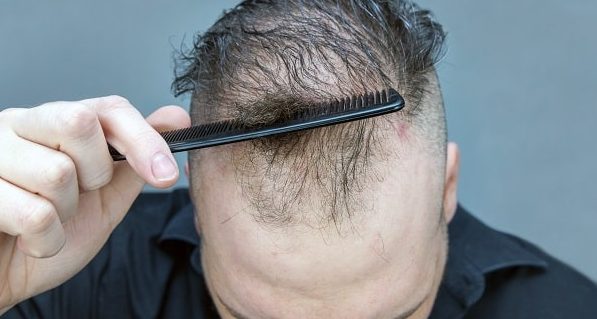 Cegah Kebotakan Dini! Cara Efektif Mengatasi Rambut Rontok Tak Wajar