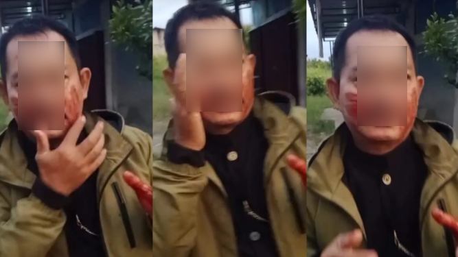 Pengendara Motor di Mempawah Terluka Parah Akibat Jeratan Benang Layangan