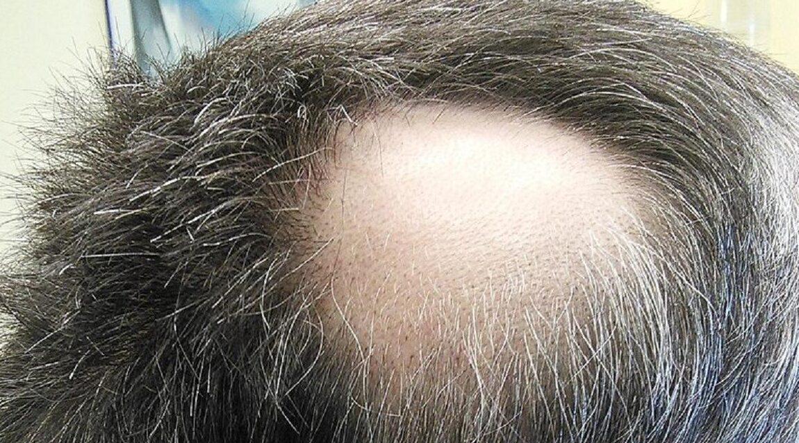 Awas! Stres Berpikir Ternyata Bisa Bikin Rambut Rontok Massal. Ini 4 Alasan Ilmiahnya