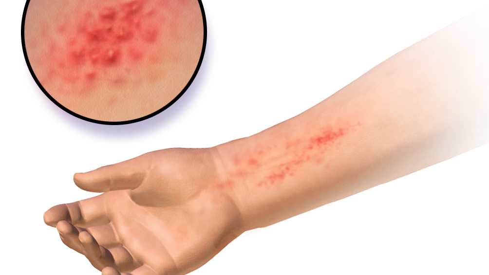 Kulit Gatal dan Meradang? Waspada 5 Penyebab Utama Dermatitis Ini