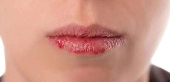 Kenapa Bibir Sering Kering Padahal Sudah Pakai Lip Balm? Ini Penyebabnya